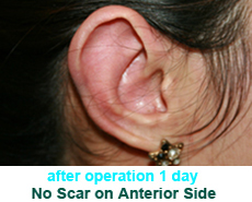 plastic-surgery-prominent-ear 